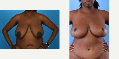 Case 847 - 35-44 year old woman treated with Mommy Makeover, Breast Lift, Breast Reduction, Tummy Tuck, Tumescent Liposuction, Vaser Liposu