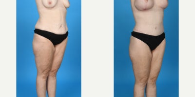 Case 8471 - 35-44 year old woman treated with Abdominal Etching, Body Lift, Diastasis Recti Repair, Drainless Tummy Tuck, Liposculpture, Lip