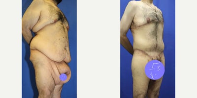 Case 8473 - Man treated with Body Lift