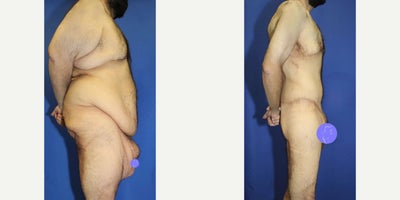 Case 8474 - Man treated with Body Lift