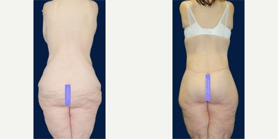 Case 8475 - 45 year old woman treated with Body Lift