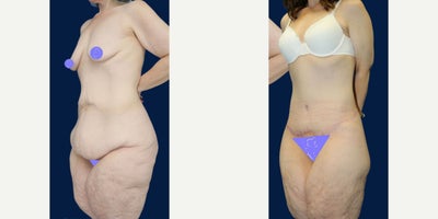 Case 8476 - 45 year old woman treated with Body Lift