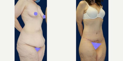 Case 8477 - 45 year old woman treated with Body Lift