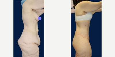 Case 8478 - 45 year old woman treated with Body Lift