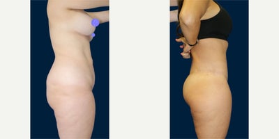 Case 8479 - Woman in her late 30s treated with Body Lift