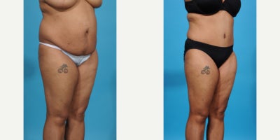 Case 848 - 35-44 year old woman treated with Tummy Tuck, Mommy Makeover, Liposuction