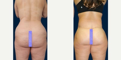 Case 8480 - Woman in her late 30s treated with Body Lift