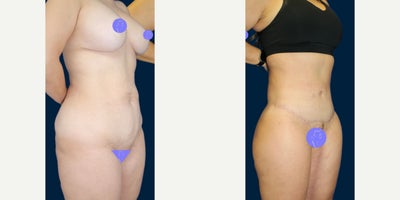 Case 8481 - Woman in her late 30s treated with Body Lift