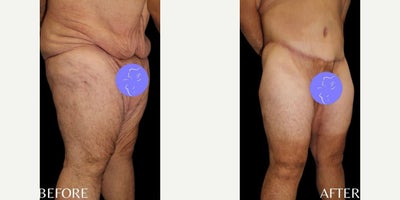 Case 8482 - 25 year old man treated with Body Lift