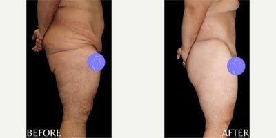 Case 8483 - 25 year old man treated with Body Lift