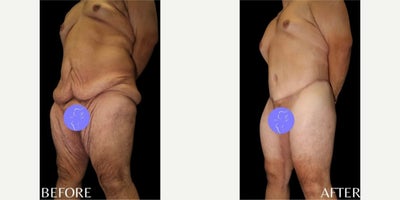 Case 8484 - 25 year old man treated with Body Lift