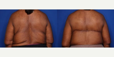 Case 8485 - 60 year old woman treated with Body Lift