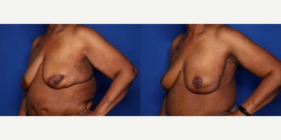 Case 8486 - 60 year old woman treated with Body Lift