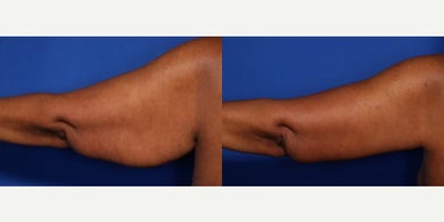 Case 8487 - 60 year old woman treated with Body Lift