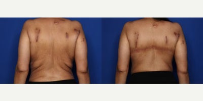 Case 8488 - 35 year old woman treated with Body Lift