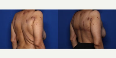 Case 8489 - 35 year old woman treated with Body Lift