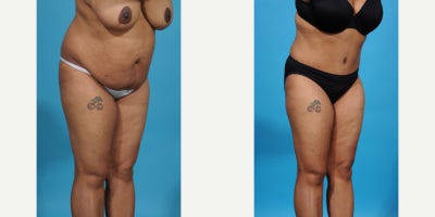 Case 849 - 35-44 year old woman treated with Tummy Tuck, Mommy Makeover, Liposuction