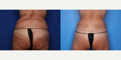 Case 8490 - 49 year old woman treated with Body Lift