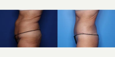 Case 8491 - 49 year old woman treated with Body Lift