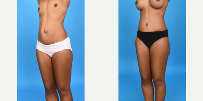 Case 8492 - 45-54 year old woman treated with Abdominal Etching, Tummy Tuck, Mini Tummy Tuck, Drainless Tummy Tuck, Vaser Liposuction, Mommy