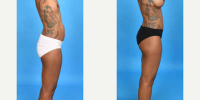 Case 8493 - 45-54 year old woman treated with Abdominal Etching, Tummy Tuck, Mini Tummy Tuck, Drainless Tummy Tuck, Vaser Liposuction, Mommy