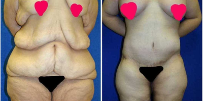 Case 8499 - 25-34 year old woman treated with Body Lift