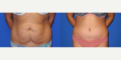 Case 85 - Woman treated with Tummy Tuck