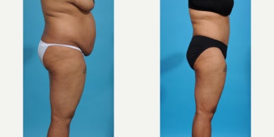 Case 850 - 35-44 year old woman treated with Tummy Tuck, Mommy Makeover, Liposuction