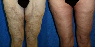 Case 8500 - 55-64 year old woman treated with Body Lift