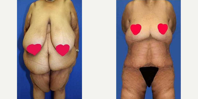 Case 8501 - 45-54 year old woman treated with Body Lift