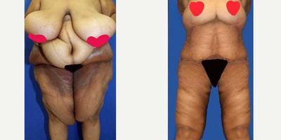 Case 8502 - 45-54 year old woman treated with Body Lift