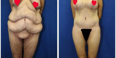 Case 8503 - 35-44 year old woman treated with Body Lift