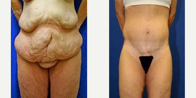 Case 8504 - 35-44 year old woman treated with Body Lift