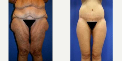 Case 8505 - 55-64 year old woman treated with Body Lift