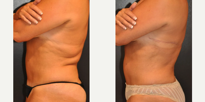 Case 8506 - 58 year old woman treated with Body Lift, Liposuction