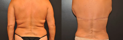 Case 8507 - 58 year old woman treated with Body Lift, Liposuction