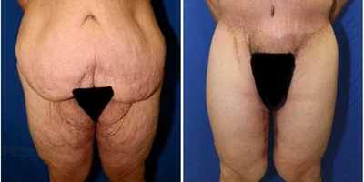 Case 8508 - 47-54 year old woman treated with Body Lift