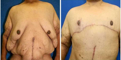 Case 8509 - 25-34 year old woman treated with Body Lift