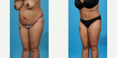 Case 851 - 35-44 year old woman treated with Tummy Tuck, Mommy Makeover, Liposuction