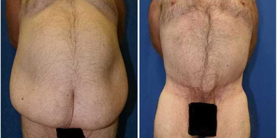 Case 8510 - Body Lift