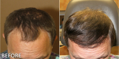 Case: 8511 - before and after photo of Man treated with Hair Transplant, ARTAS Robotic Hair Transplant by Gregory Turowski, MD, PhD, FACS