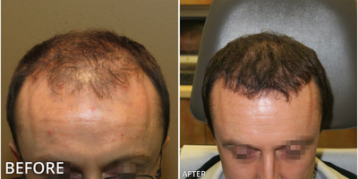Case: 8512 - before and after photo of Man treated with Hair Transplant, ARTAS Robotic Hair Transplant by Gregory Turowski, MD, PhD, FACS