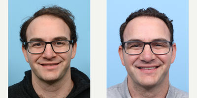 Case: 8513 - before and after photo of 25-34 year old man treated with FUE Hair Transplant, Hair Transplant, Hair Loss Treatment, PRP for Hair Loss by Jeffrey B. Wise, MD, FACS