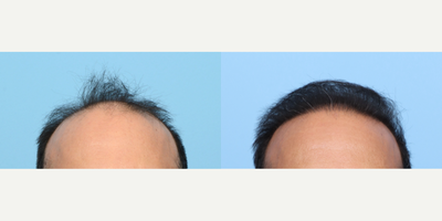 Case: 8514 - before and after photo of 45-54 year old man treated with FUE Hair Transplant, Hair Transplant, Hair Loss Treatment, PRP for Hair Loss by Jeffrey B. Wise, MD, FACS