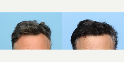 Case: 8515 - before and after photo of 55-64 year old man treated with FUE Hair Transplant, Hair Transplant, Hair Loss Treatment, PRP for Hair Loss by Jeffrey B. Wise, MD, FACS