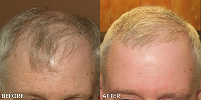 Case: 8516 - before and after photo of Man treated with ARTAS Robotic Hair Transplant, Hair Transplant by Gregory Turowski, MD, PhD, FACS