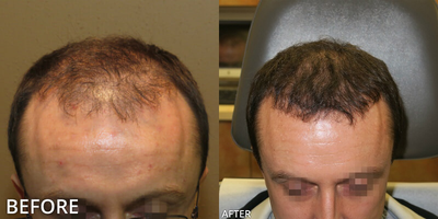 Case: 8517 - before and after photo of Man treated with ARTAS Robotic Hair Transplant, Hair Transplant by Gregory Turowski, MD, PhD, FACS