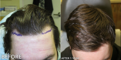 Case: 8518 - before and after photo of Man treated with Hair Transplant, ARTAS Robotic Hair Transplant by Gregory Turowski, MD, PhD, FACS