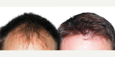 Case: 8519 - before and after photo of Man treated with Hair Transplant by Robert Colgrove, Jr., MD