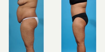 Case 852 - 35-44 year old woman treated with Tummy Tuck, Mommy Makeover, Liposuction